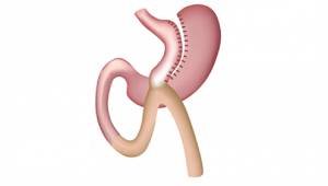 Mini Gastric Bypass