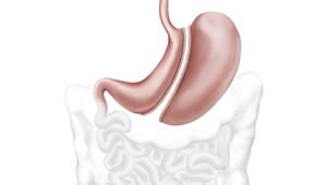 Sleeve Gastrectomy
